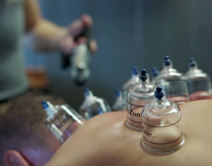 Cupping treatment at Maverick Chiropractic in Naperville, IL
