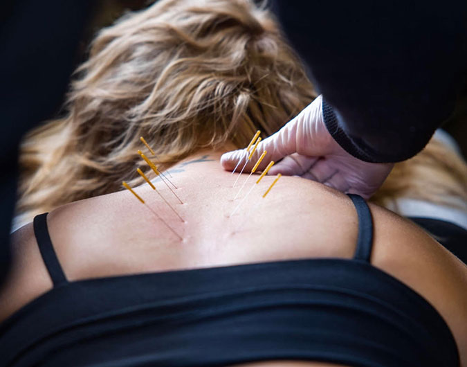 acupuncture services at Maverick Chiropractic in Naperville, IL