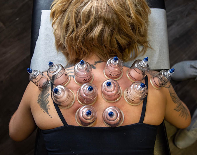 cupping services at Maverick Chiropractic in Naperville, IL