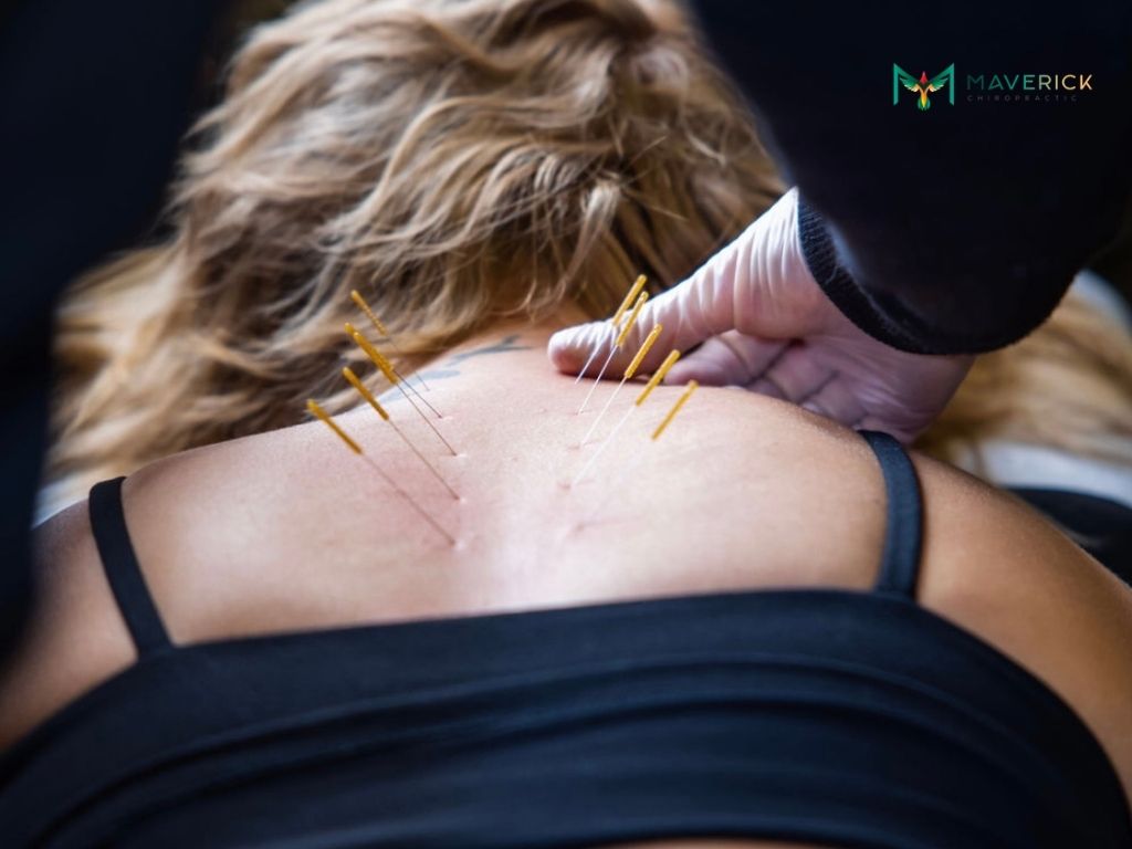 Acupuncture at Maverick Chiropractic in Naperville, IL