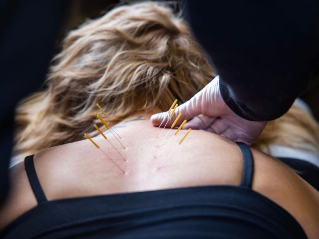 Acupuncture Naperville