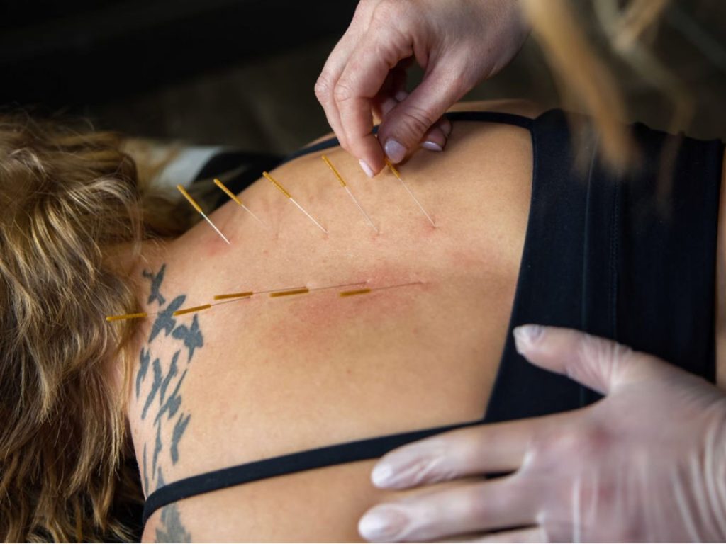 acupuncturist Naperville